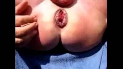 Gay Men Monster Extrem Asshole Anus After Gape Hole Prolapse Assplay Analdehner all gay porn video